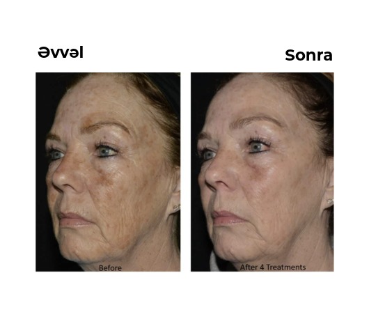 Lutronic LaseMD Ultra